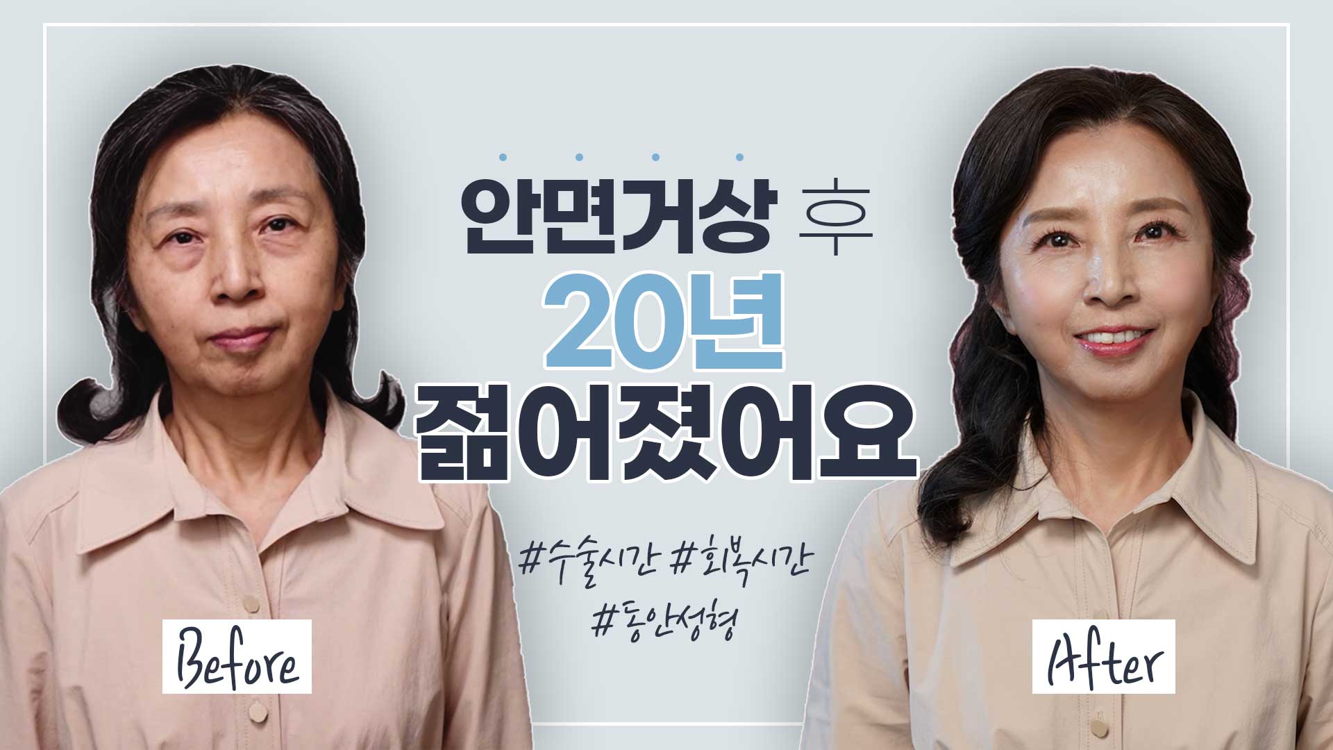 안면거상+목거상+상안검+하안검 수술 환자 6개월차!!